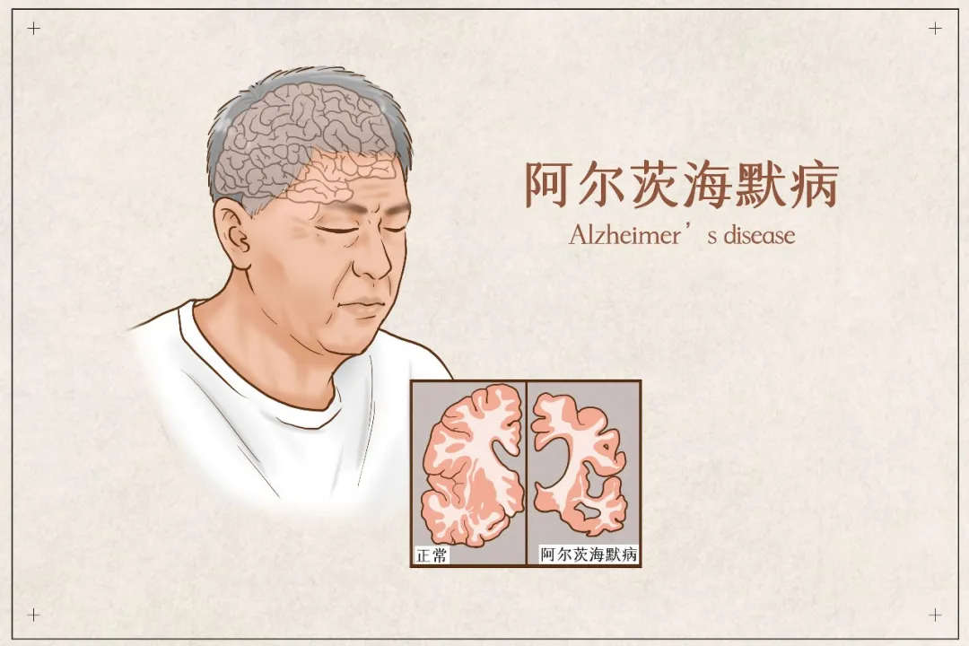 Medical illustration comparing a healthy brain with an Alzheimer's-affected brain — highlighting the importance of early detection