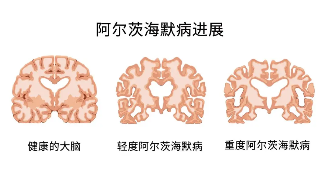 Illustration comparing brain changes in a healthy brain, mild Alzheimer's disease, and severe Alzheimer's disease