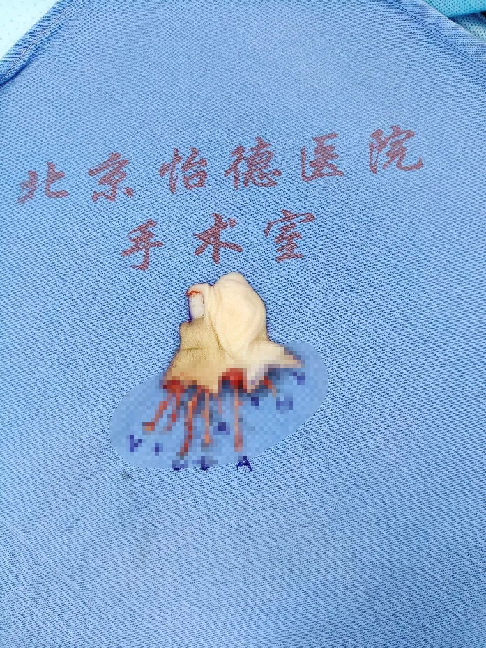Restoring natural length, proportion, and appearance of the reconstructed finger