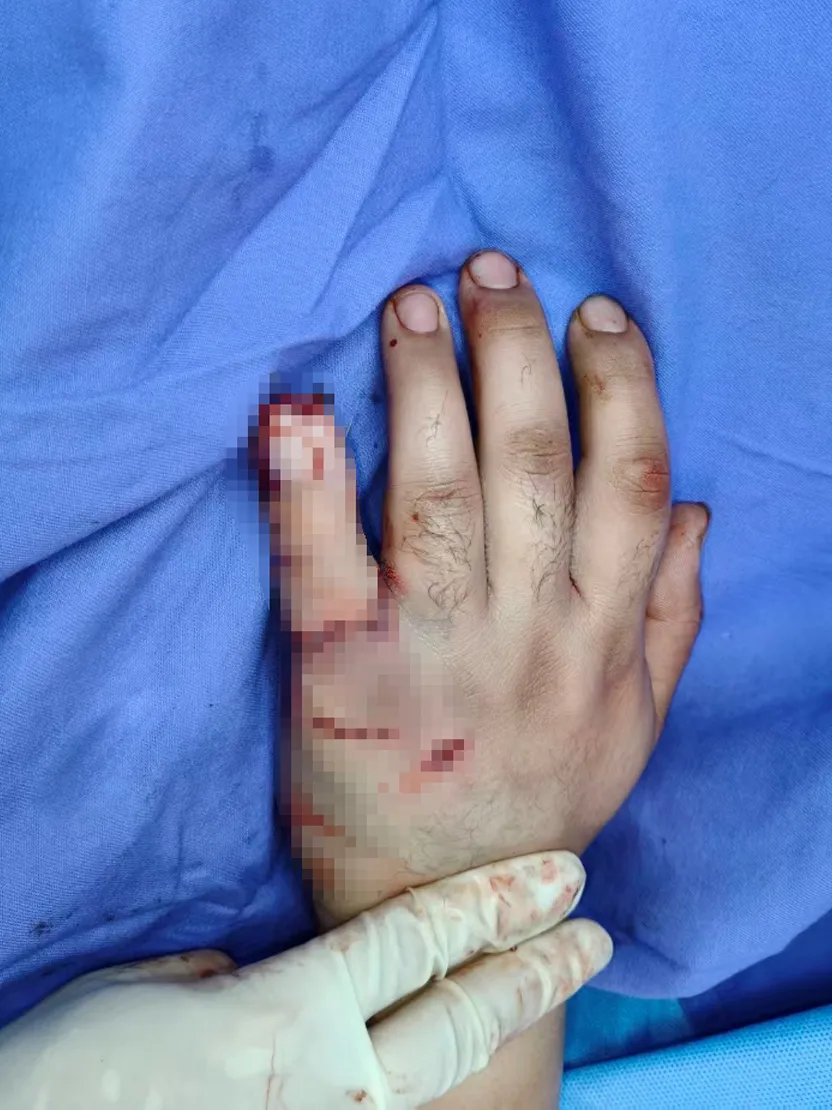 Post-operative recovery and rehabilitation after finger reconstruction