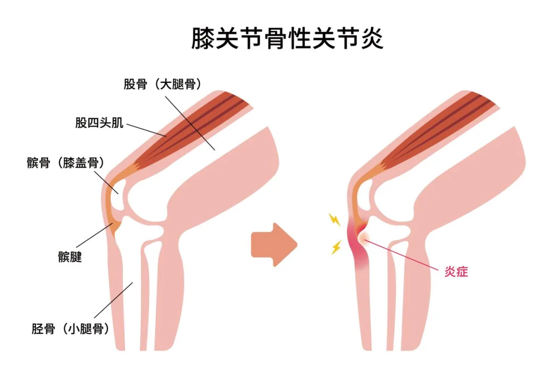 Diagram of the quadriceps, patella and patellar tendon, and knee joint inflammation