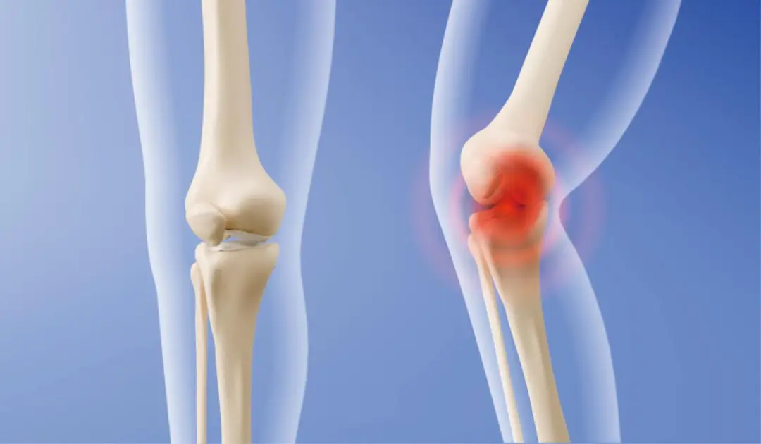 Medical illustration of knee joint inflammation and pressure during movement