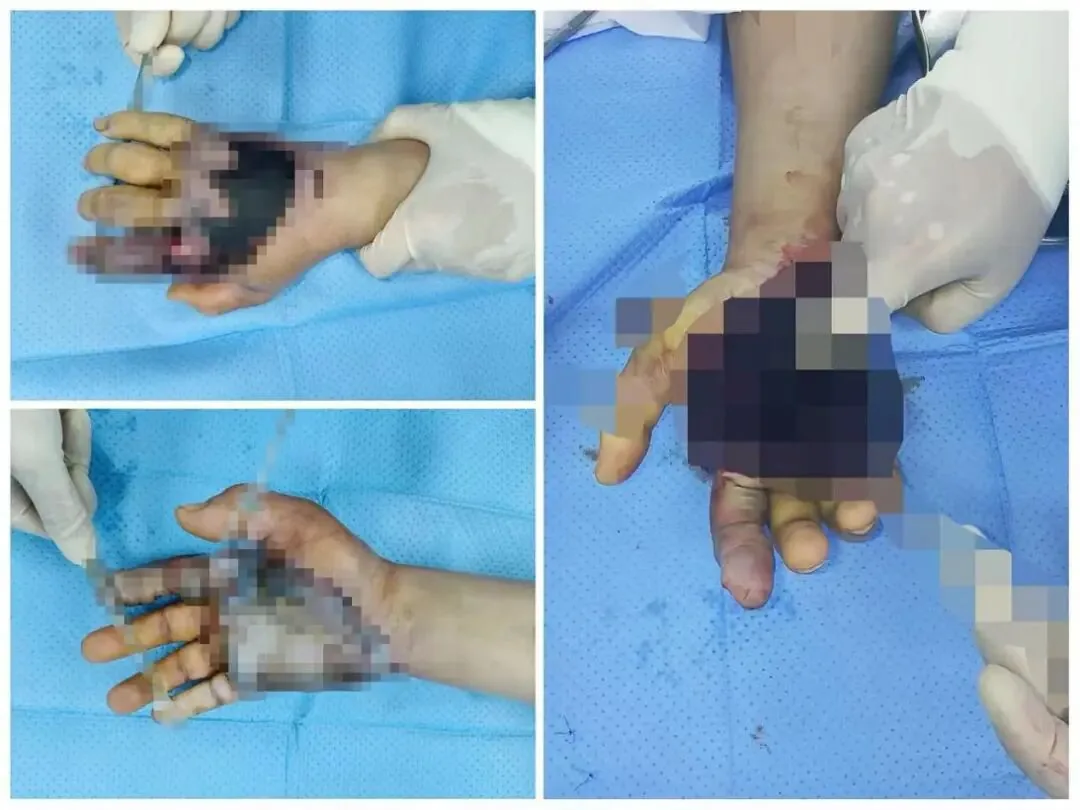 Image accompanying the section on what skin changes after a crush injury may indicate